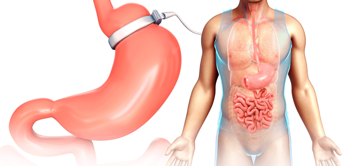 Bendaggio Gastrico Napoli