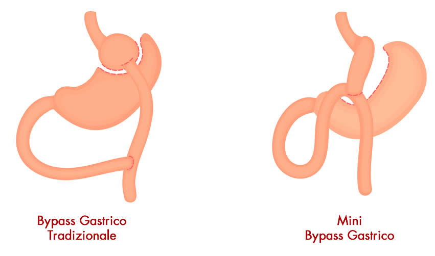 mini-bypass-gastrico-napoli